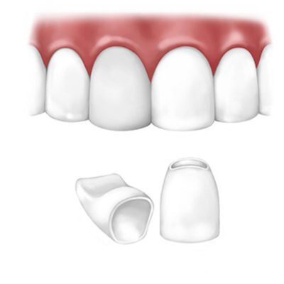 Dental Bridge